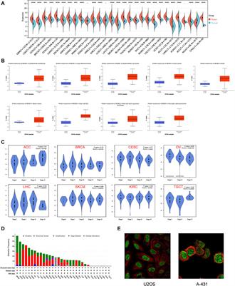 The prognostic and immunological role of MCM3 in pan-cancer and validation of prognosis in a clinical lower-grade glioma cohort